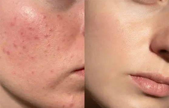 أعشاب ومكونات طبيعية تُستخدم في العلاج الطبيعي لـ حب الشباب.