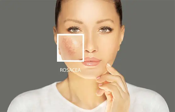 صورة توضيحية لروتين الـ 5 خطوات لـ البشرة الحساسة يركز على تقوية حاجز البشرة.